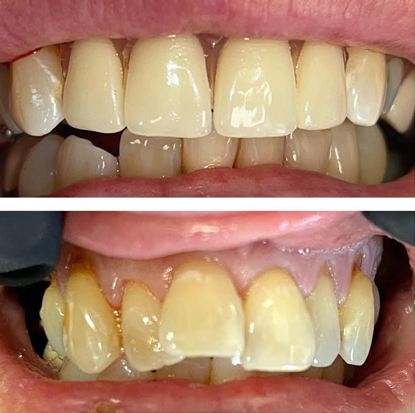 Before and after Implant