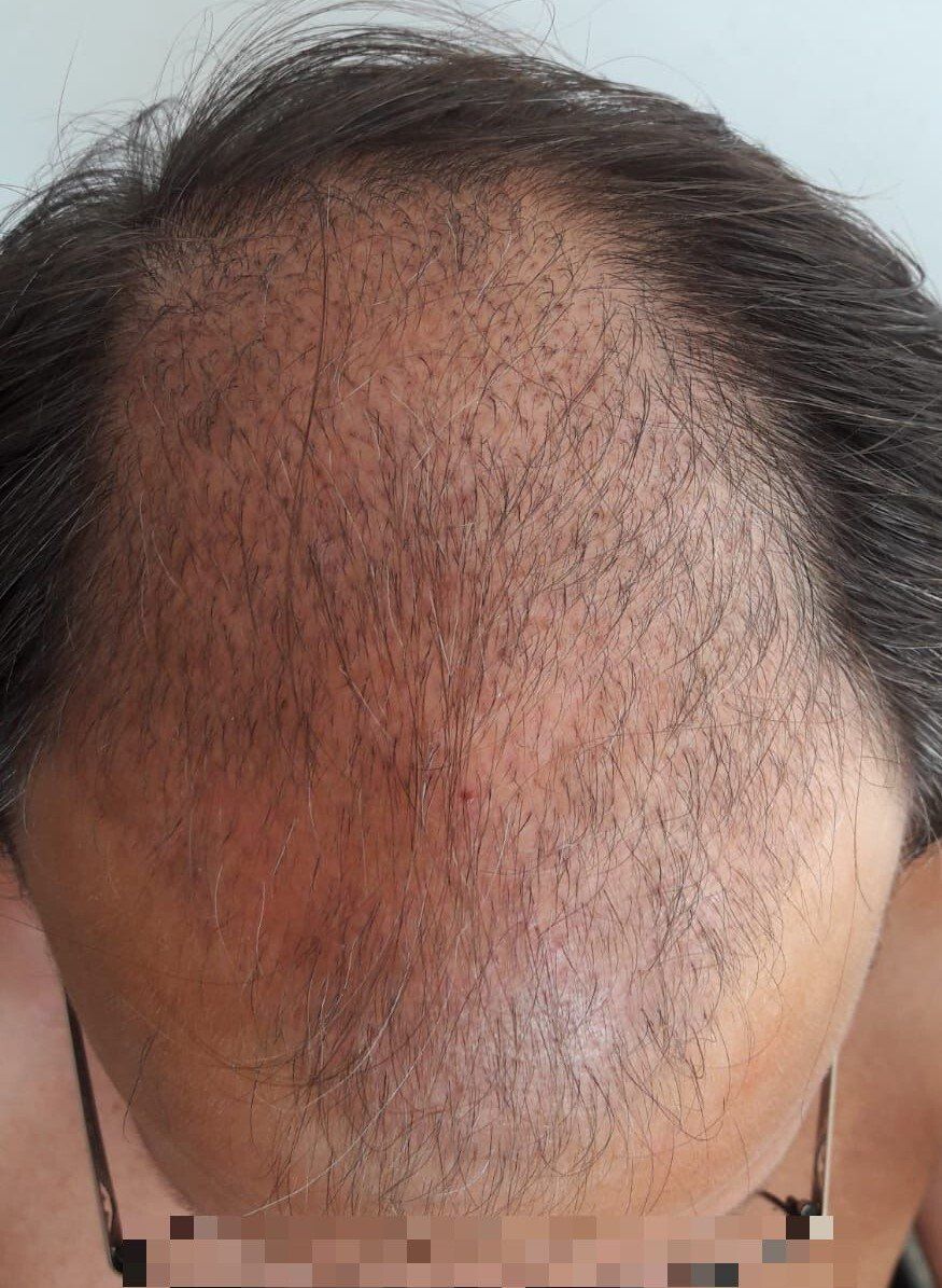 Trapianto di capelli