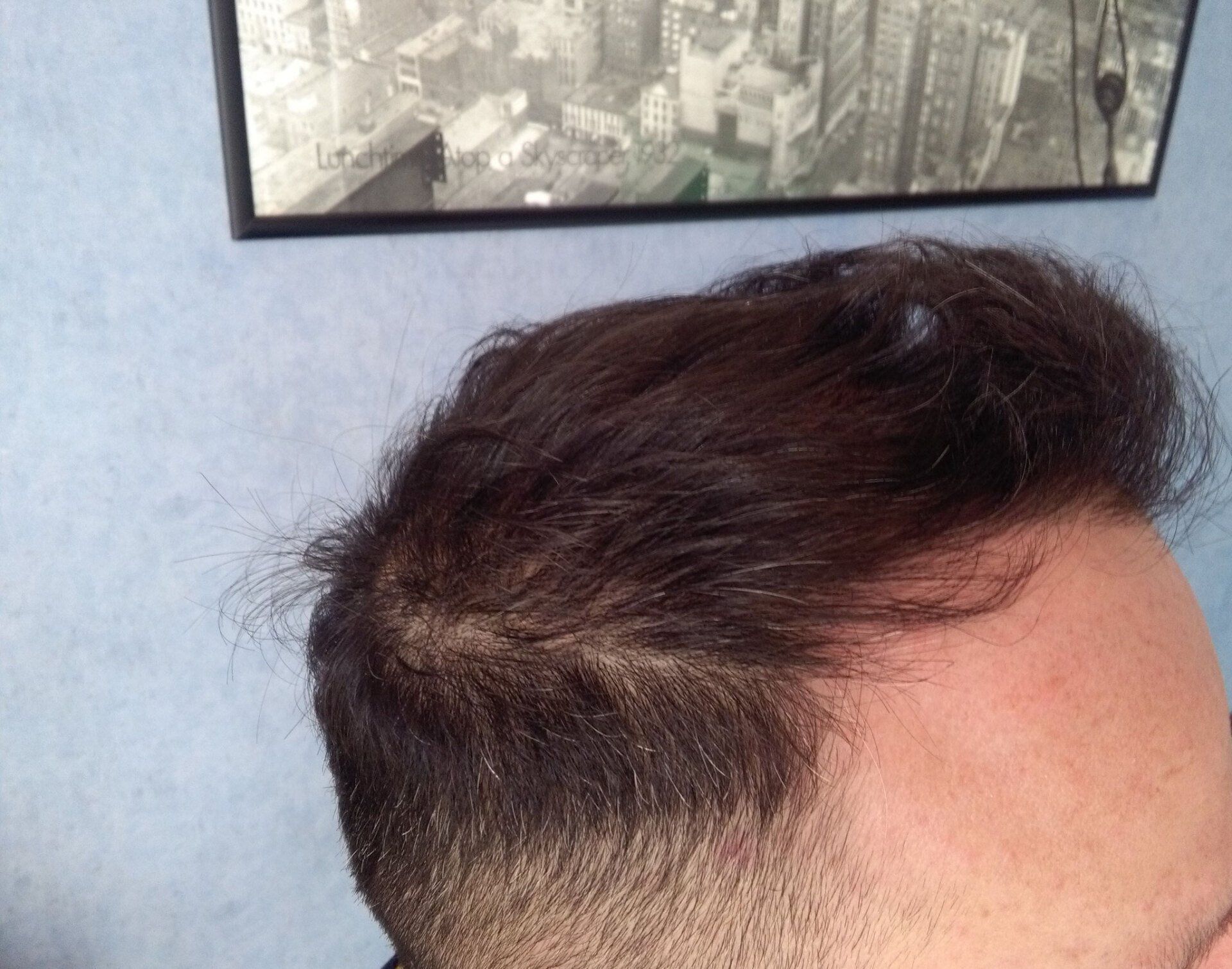 Trapianto di capelli