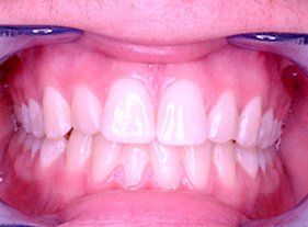 Cosmetic dentistry - 1 after