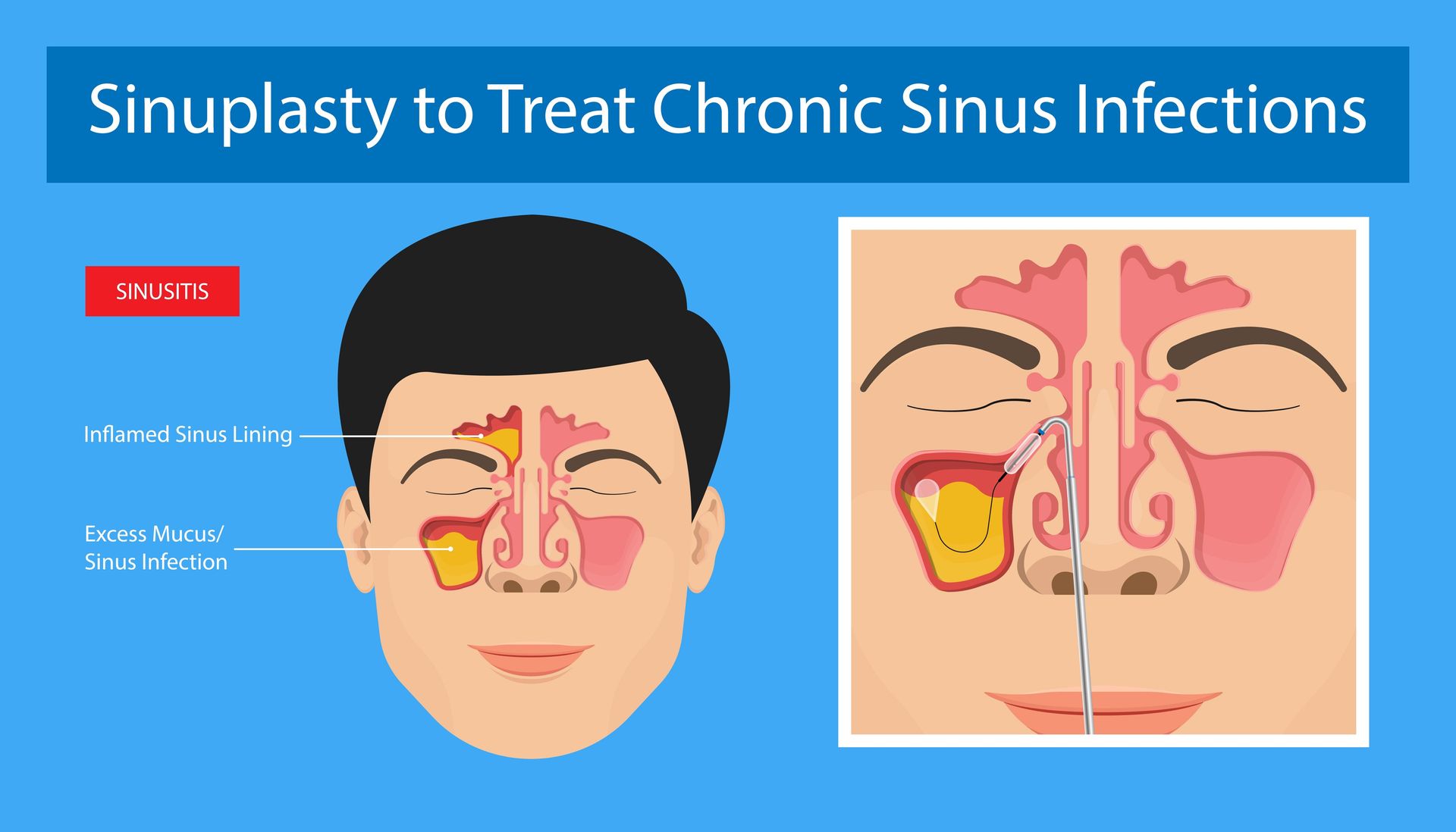 Infographic on sinoplasty for chronic sinus infections, showing nasal passages and treatment diagram on blue background