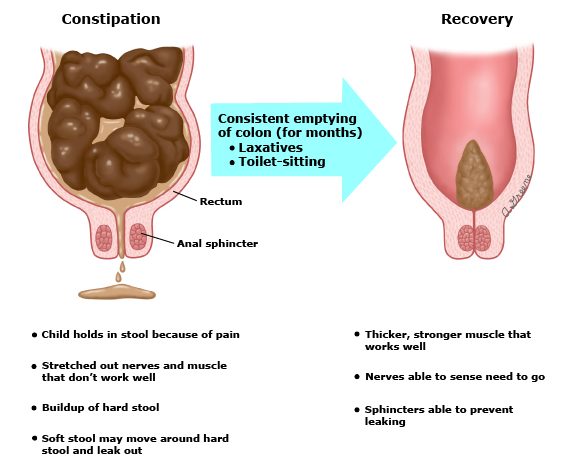 Diagram showing constipation and recovery in the colon and anus, with labels on stool and sphincter function