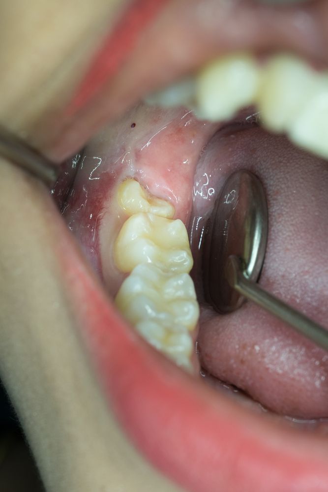 Dental Mirror Reflects an Open Mouth — Killara Dental in East Killara, NSW
