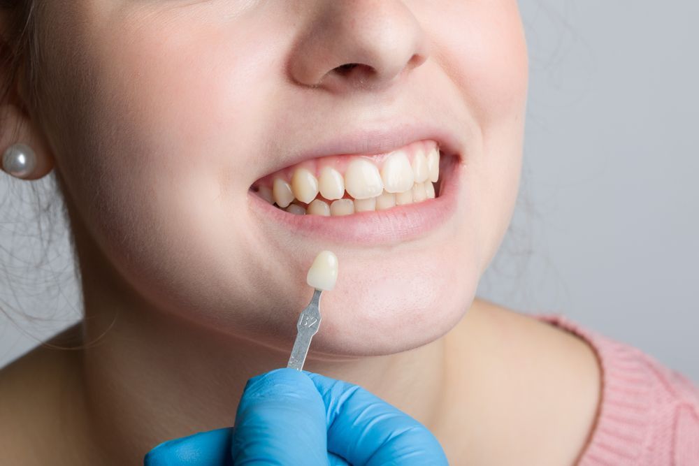 Dentist Holding a Tooth Shade Guide Against a Patient's Natural Teeth — Killara Dental in East Killara, NSW