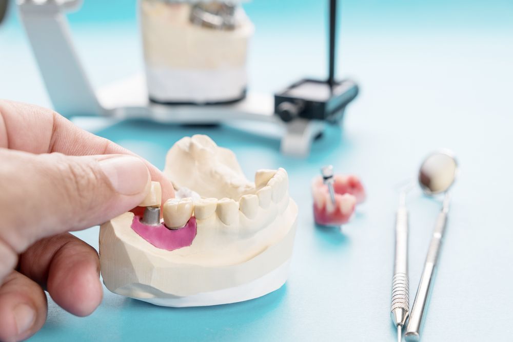 Person's Hand Places a Crown Onto a Dental Model — Killara Dental in East Killara, NSW