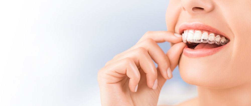 Person’s Hand Adjusting a Clear Plastic Aligner — Killara Dental in East Killara, NSW
