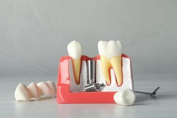 A Dental Model Showing a Metal Tooth Implant Between Two Natural Teeth — Killara Dental in East Killara, NSW