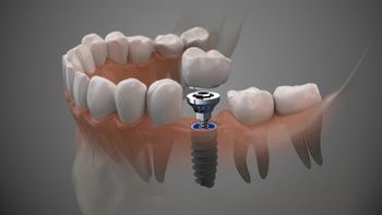A 3D Medical Illustration Showing a Dental Implant — Killara Dental in East Killara, NSW