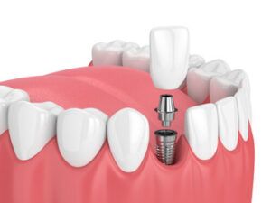 A 3D Dental Illustration Showing a Tooth Implant — Killara Dental in East Killara, NSW