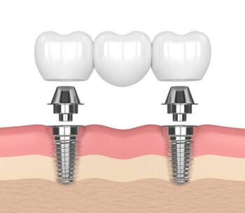 A 3d Dental Illustration Showing a Three-unit Bridge — Killara Dental in East Killara, NSW