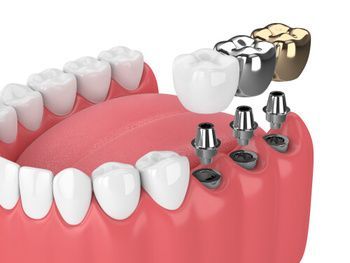Dental Implants Shown With Various Crown Types — Killara Dental in East Killara, NSW