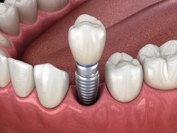 A 3D Illustration of a Dental Implant With a Porcelain Crown — Killara Dental in East Killara, NSW