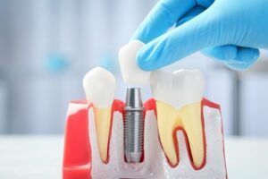 A Hand in a Blue Medical Glove Placing a White Dental Crown — Killara Dental in East Killara, NSW