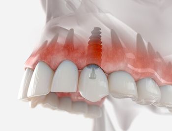 A 3D Medical Illustration of a Dental Implant Placed in the Upper Jaw — Killara Dental in East Killara, NSW