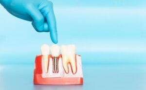 A Gloved Finger Points to a Dental Implant Model — Killara Dental in East Killara, NSW