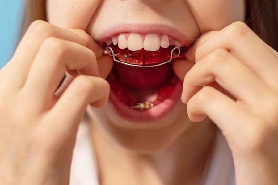 A Close Up of a Person Mouth With Braces on Their Teeth — ProCare Dental Australia in East Maitland, NSW