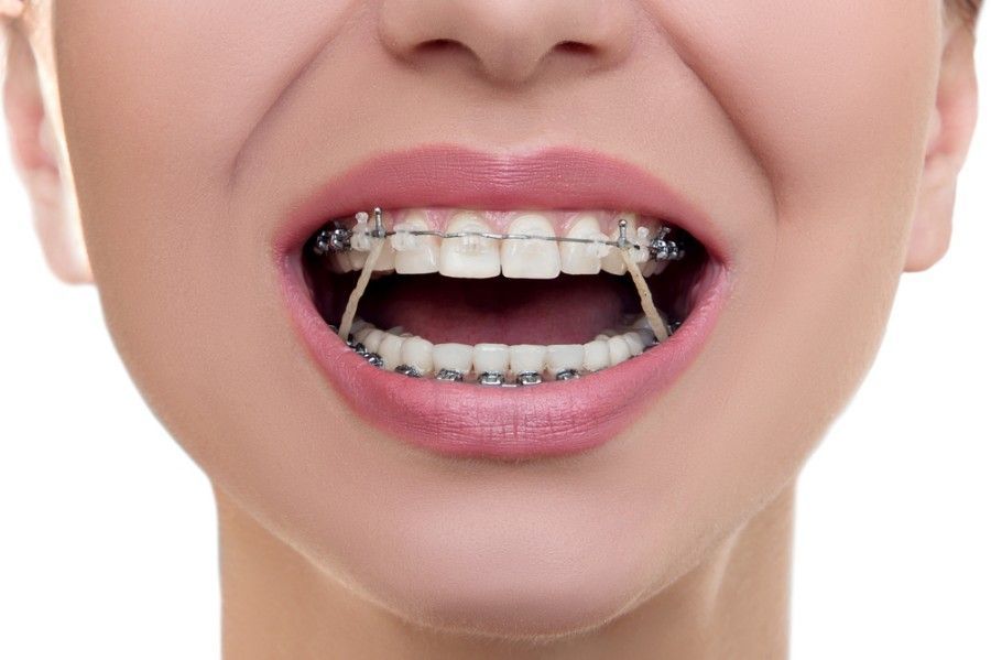 A Close Up of a Woman Mouth With Braces on Her Teeth — ProCare Dental Australia in East Maitland, NSW