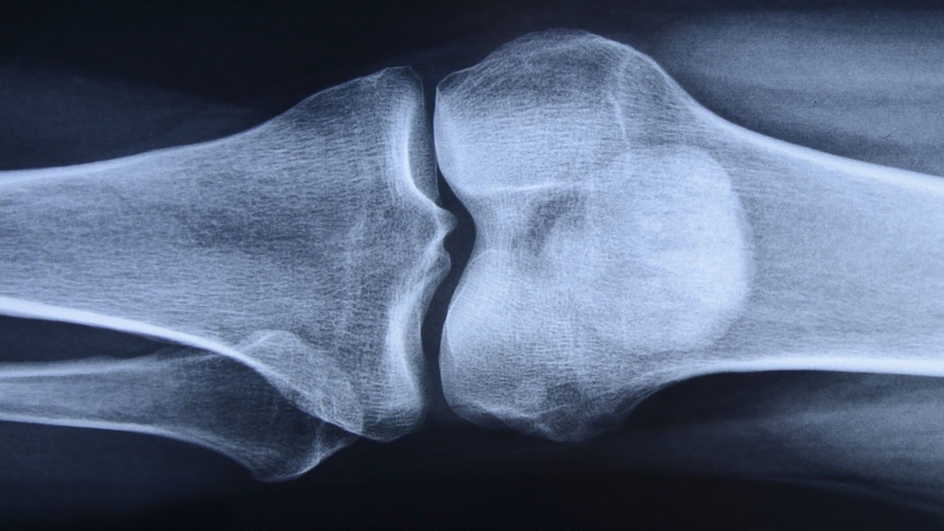 An x-ray of a knee showing a broken knee joint.
