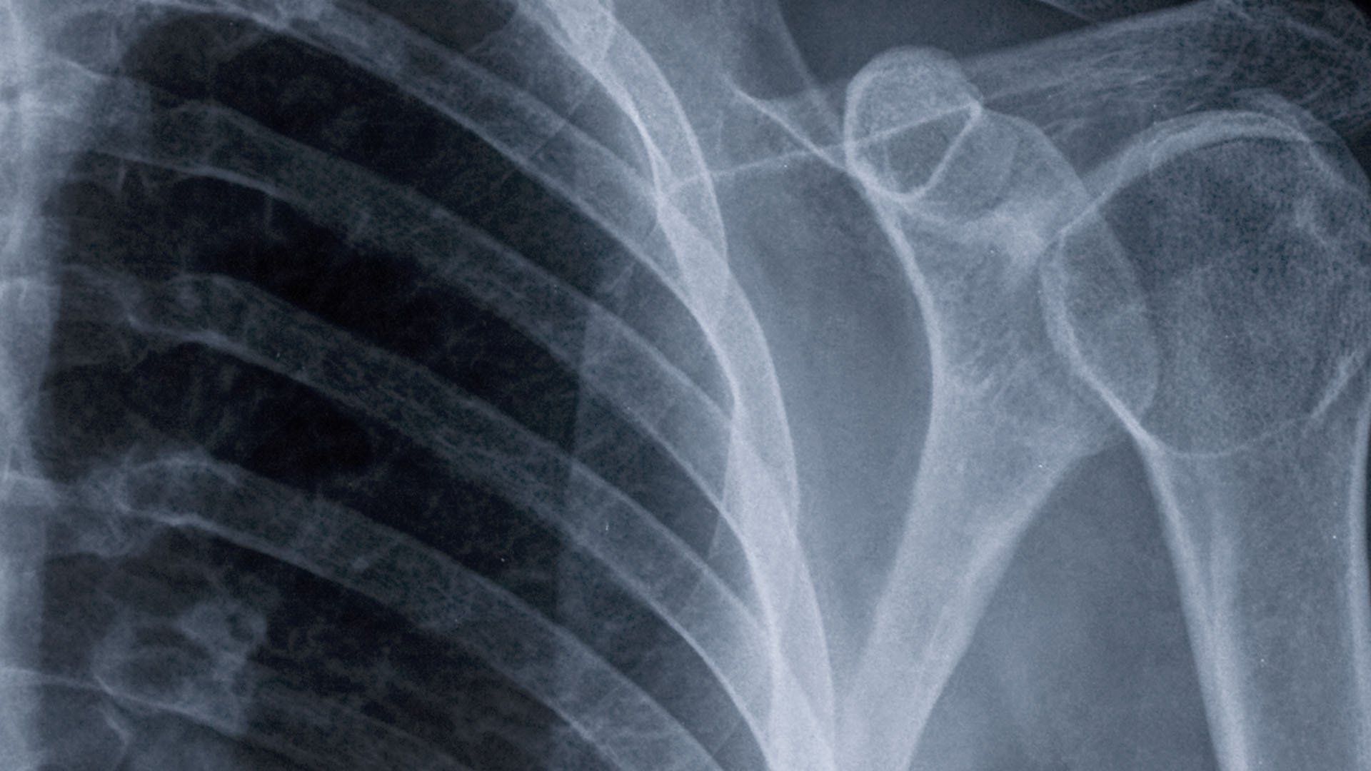 A close up of an x-ray of a person 's shoulder and chest.