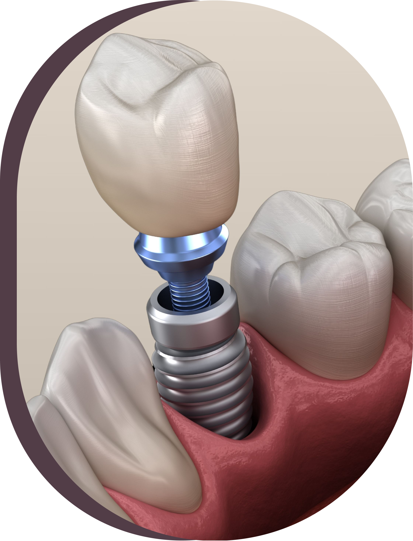 A close up of an implant with crown and abutment