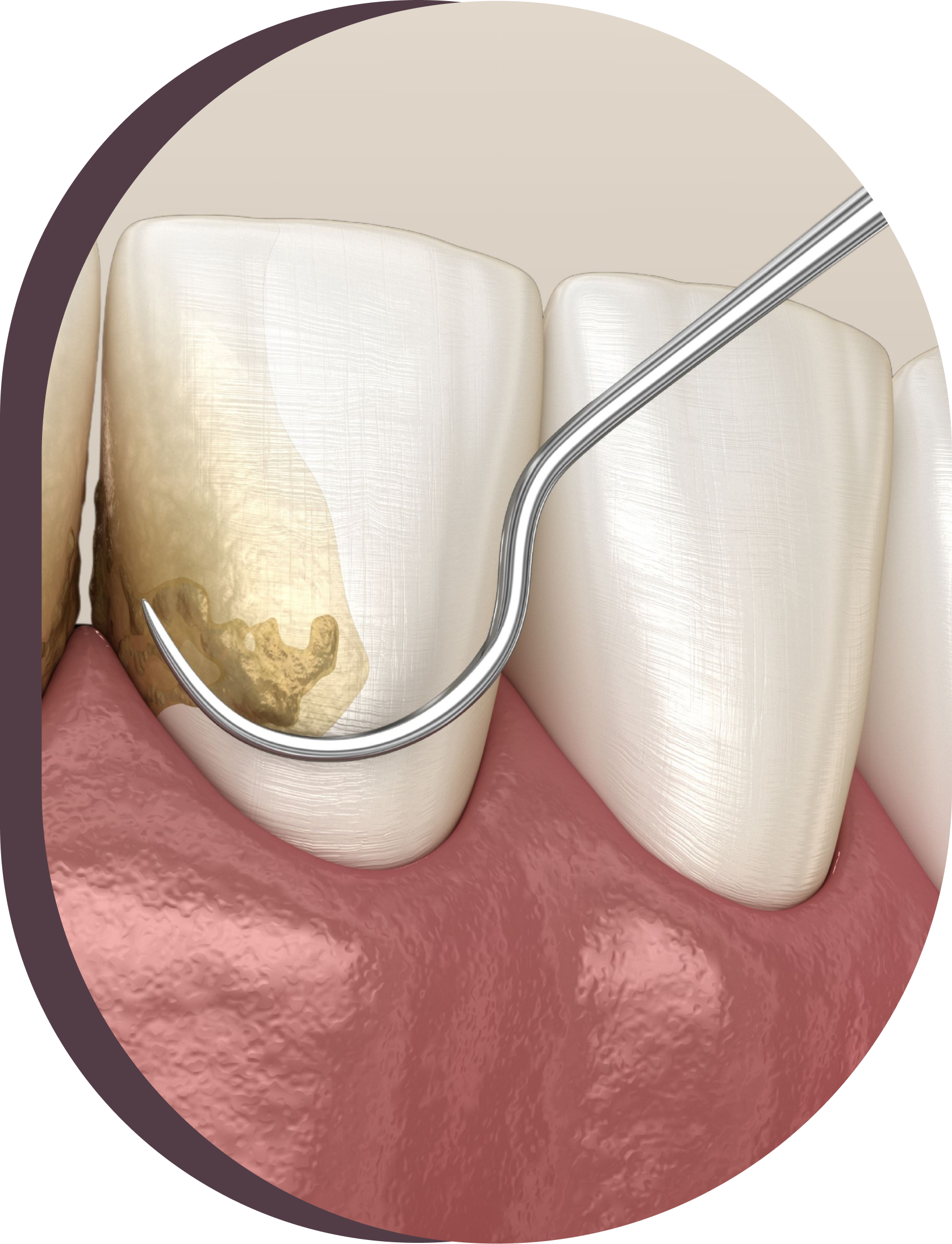 A close up of Periodontal services