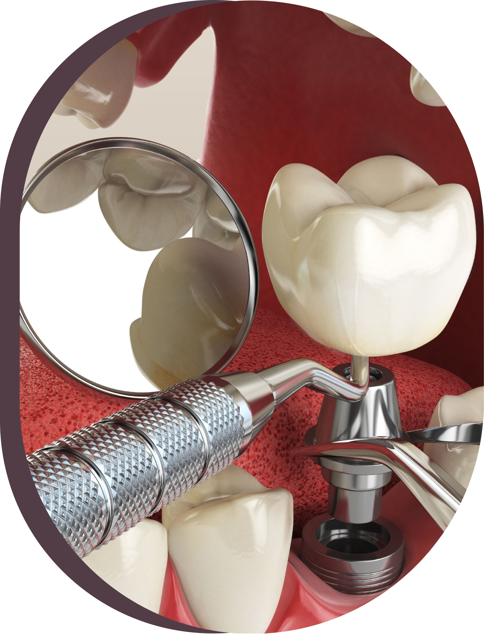 A dental implant is being examined by a dentist