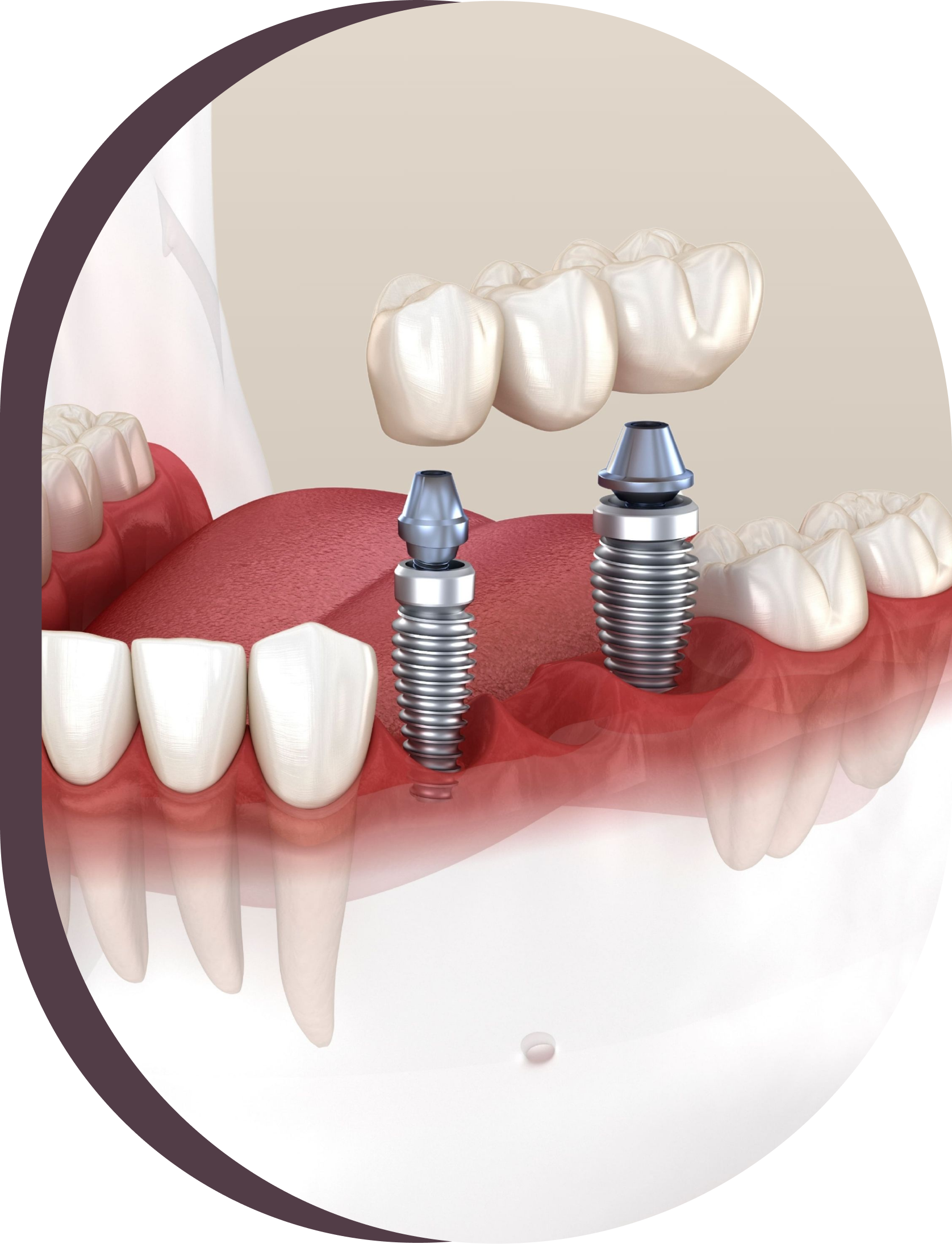 A model of a mouth with dental implants in it