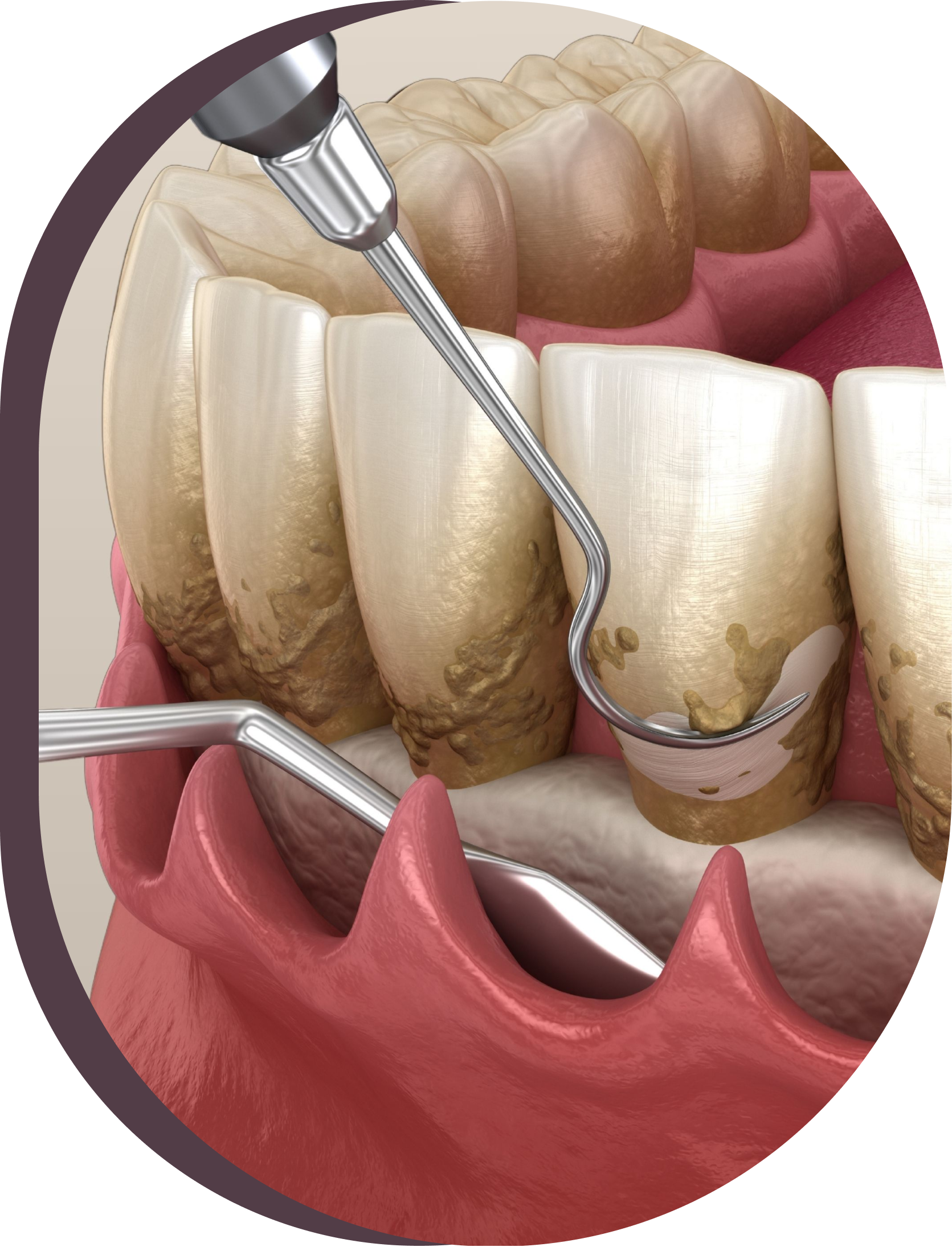 A close up of a person 's teeth being examined by a dentist