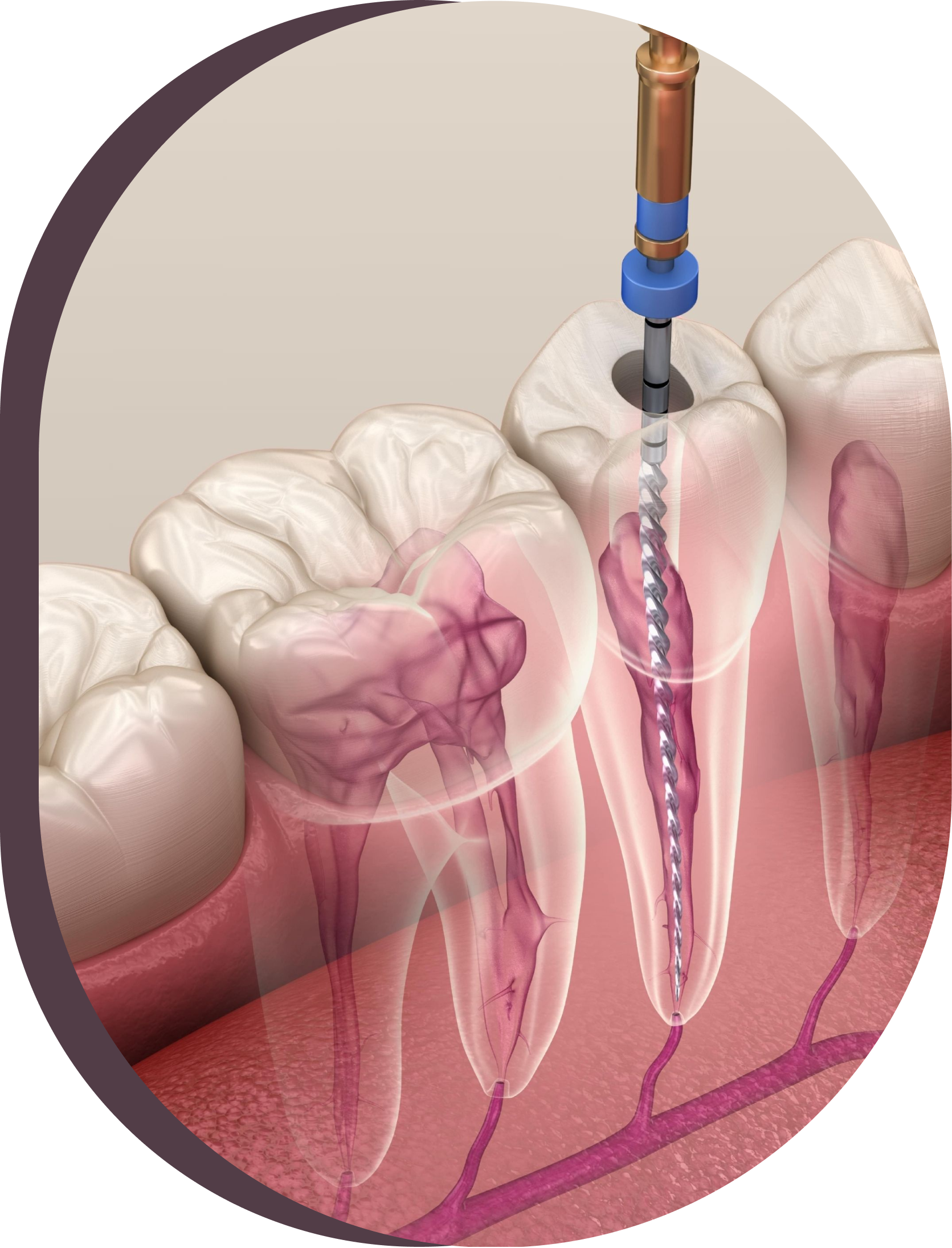 A close up of a tooth with a drill in it