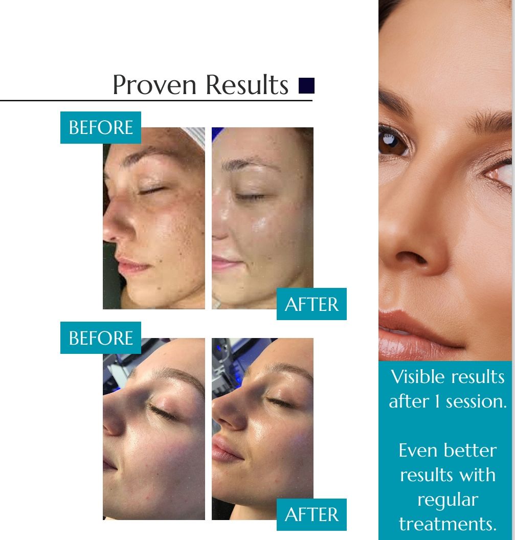 hydra facials harrow pre launch