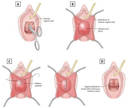 Bladder prolapse repair