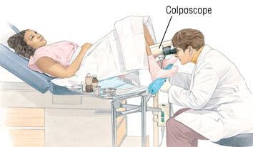 Colposcopy