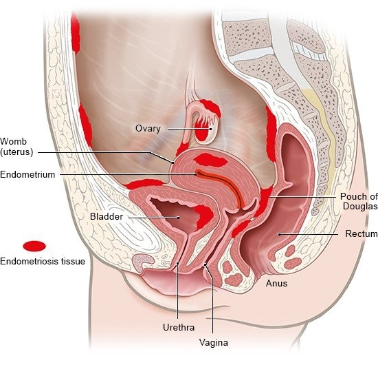 Endometriosis