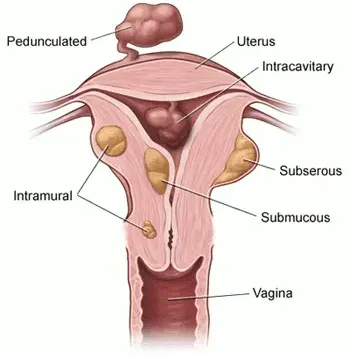 Fibroids