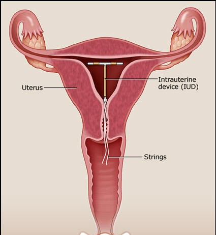 Mirena, Copper IUD Insertion