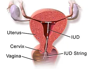 IUD Mirena