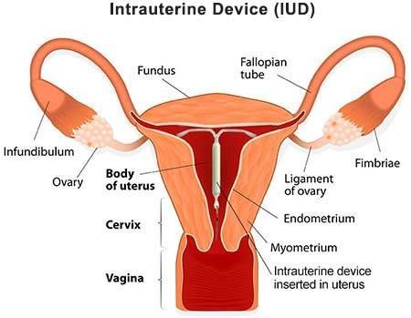 Intrauterine-Device-IUD