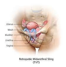 Urinary Incontinence