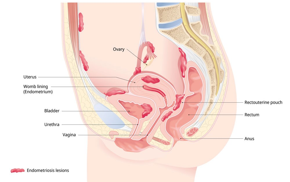 Endometriosis & Adenomyosis 2