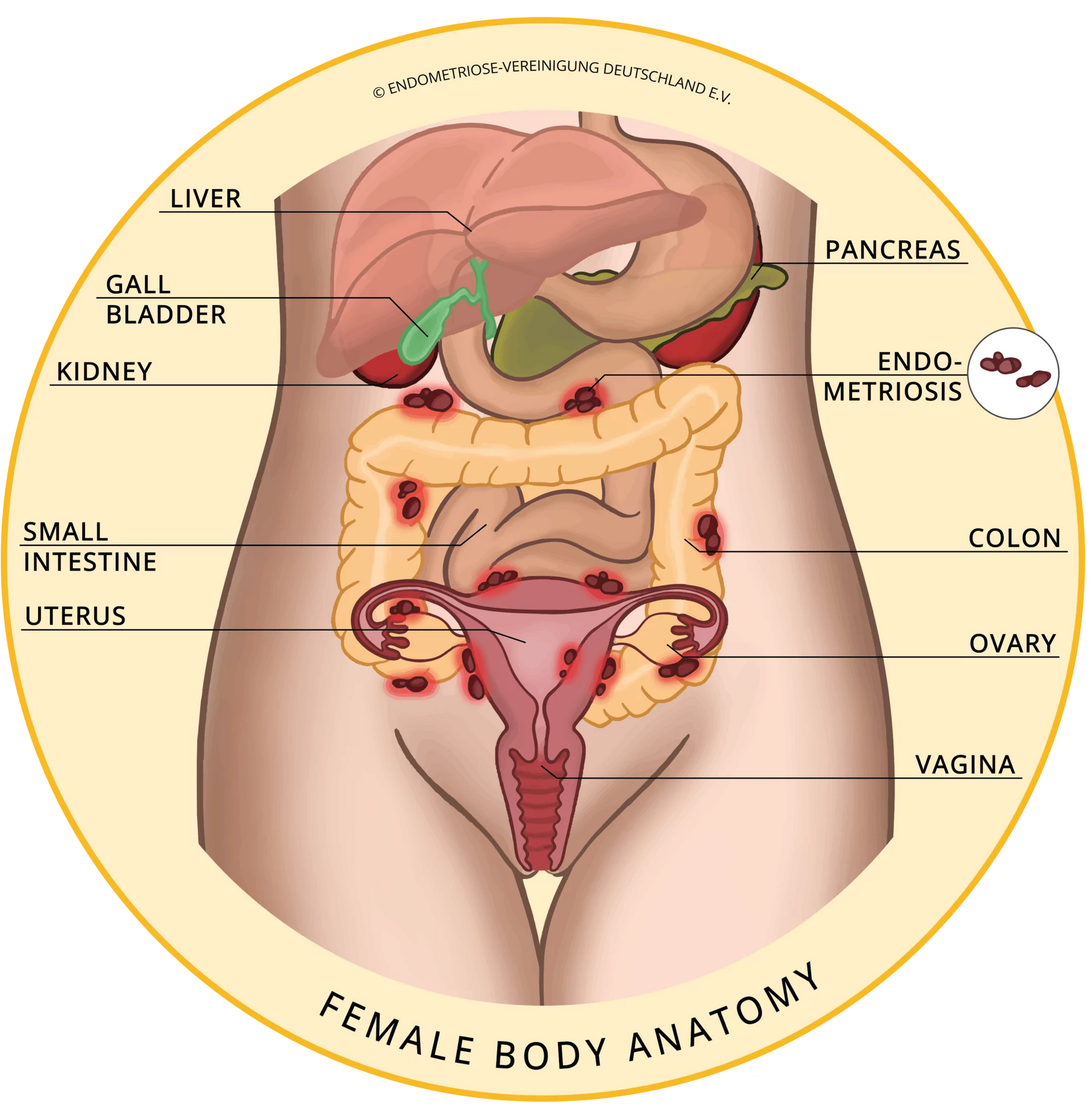 Endometriosis & Adenomyosis