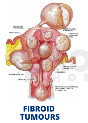 Fibroids 2