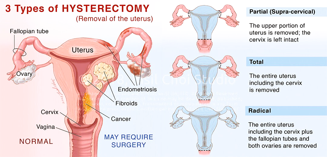 Hysterectomy