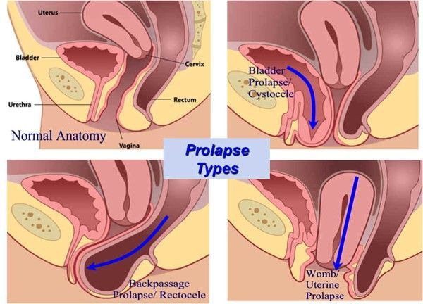 Prolapse Types