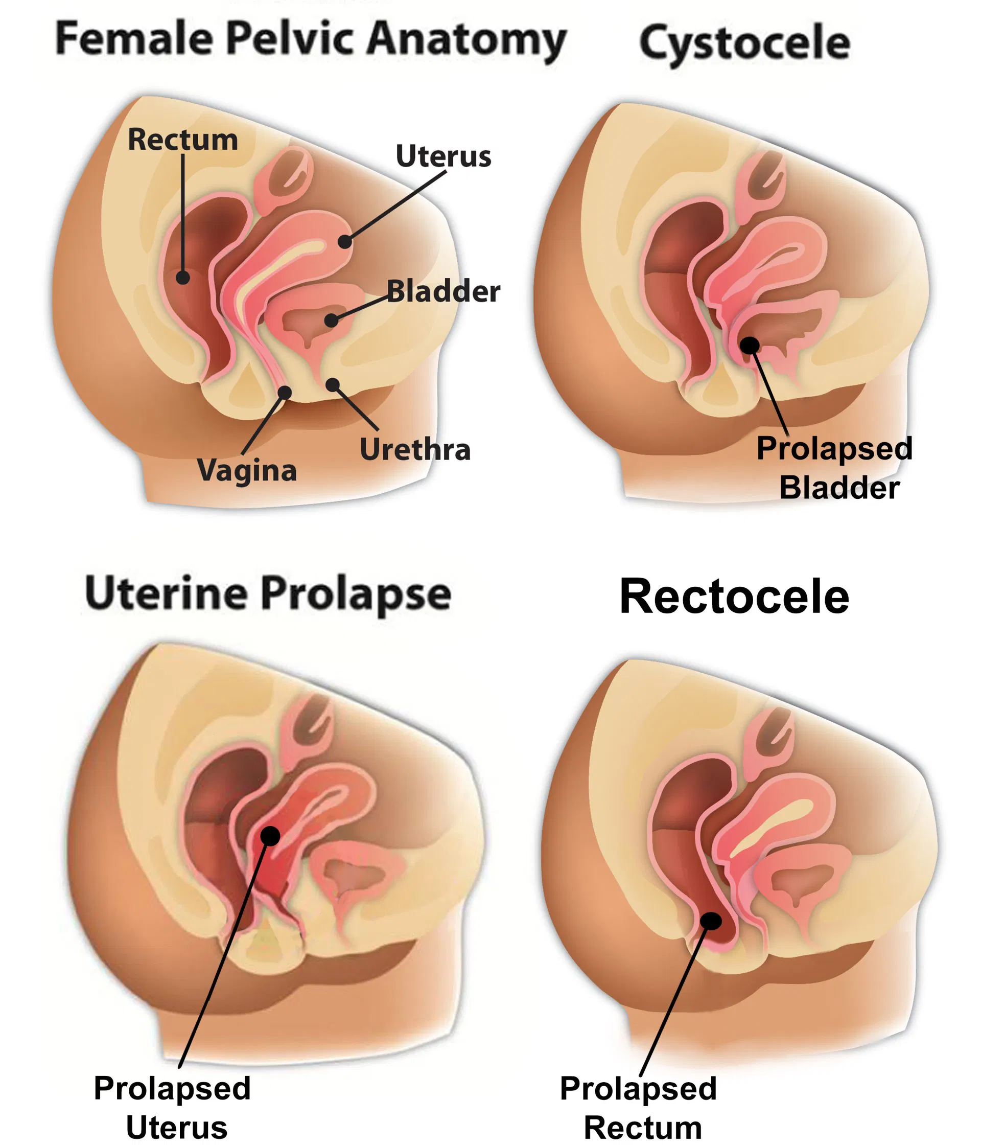 Uterine Prolapse