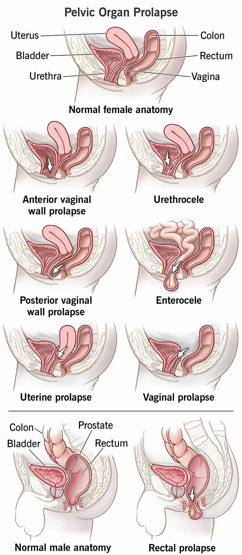 Prolapse