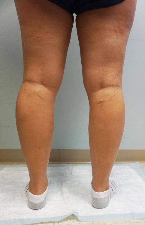 A woman 's legs are shown from the back while standing on a towel.