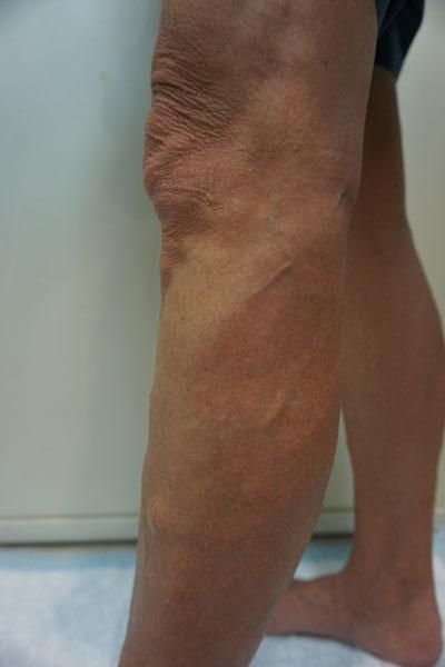 A close up of a person 's leg with varicose veins.