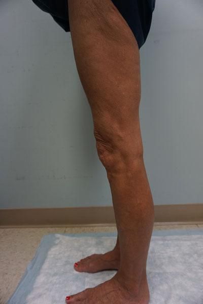 A woman with varicose veins on her legs is standing on a towel.