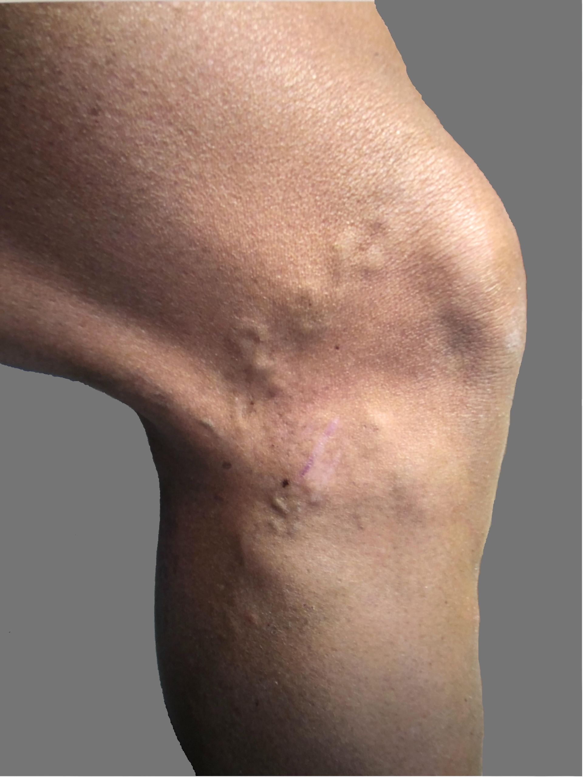 A close up of a person 's leg with varicose veins