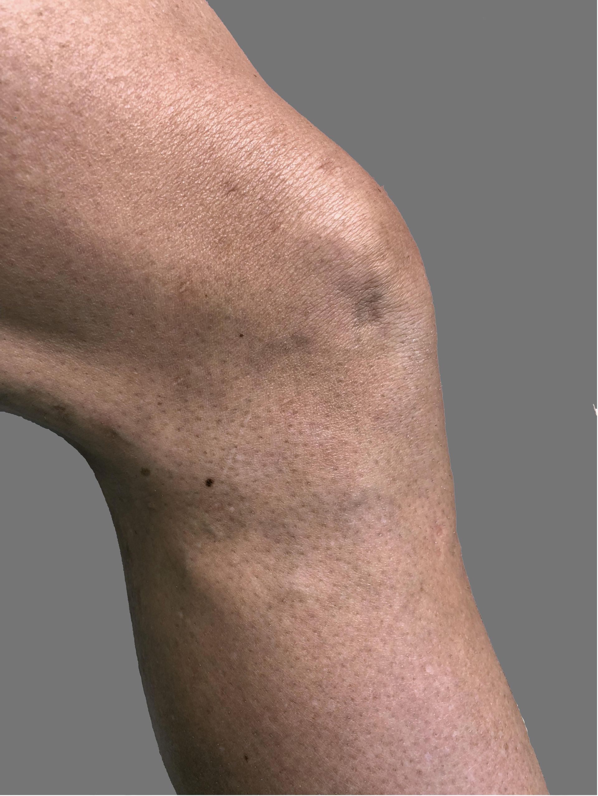 A close up of a person 's knee with varicose veins.